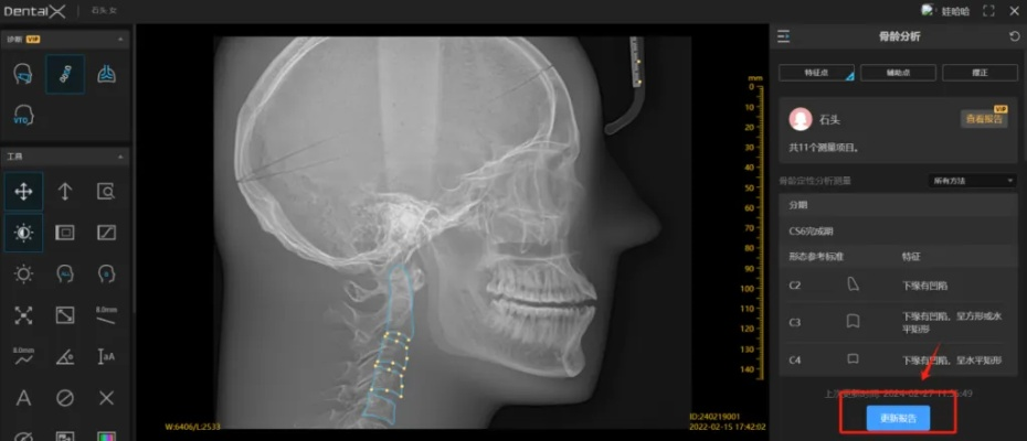 骨骼扫描官方下载和广电新版本,详细数据解释定义|DX版1_v9.914